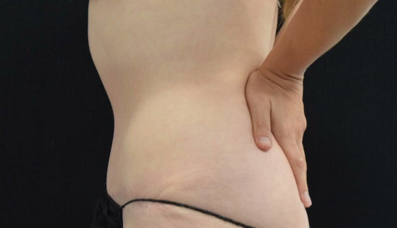 Abdominoplasty Before & After Gallery - Patient 102425575 - Image 8