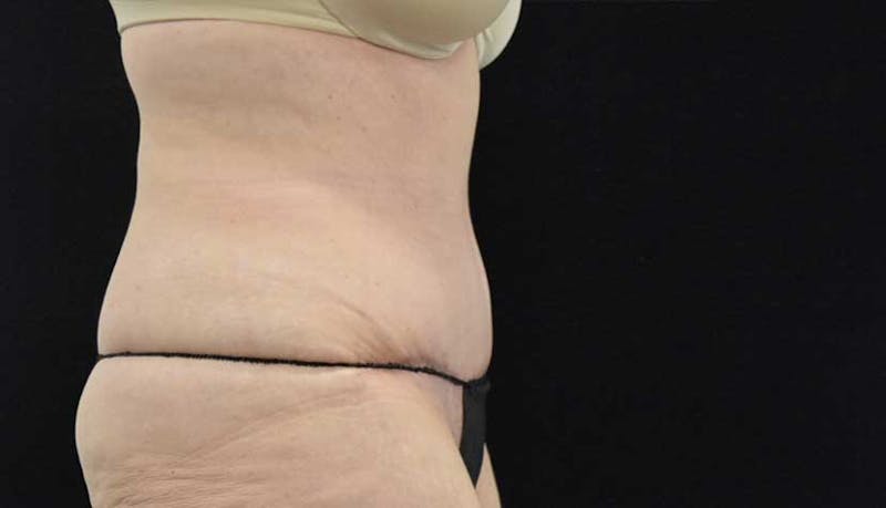 Massive Weight Loss Gallery - Patient 102425578 - Image 8