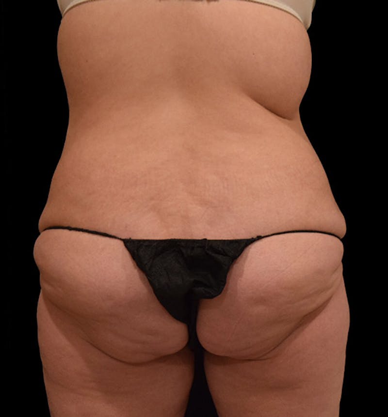 Lower Body Lift Before & After Gallery - Patient 102425579 - Image 11