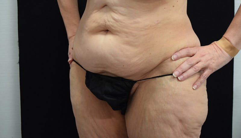 Massive Weight Loss Before & After Gallery - Patient 102425578 - Image 9