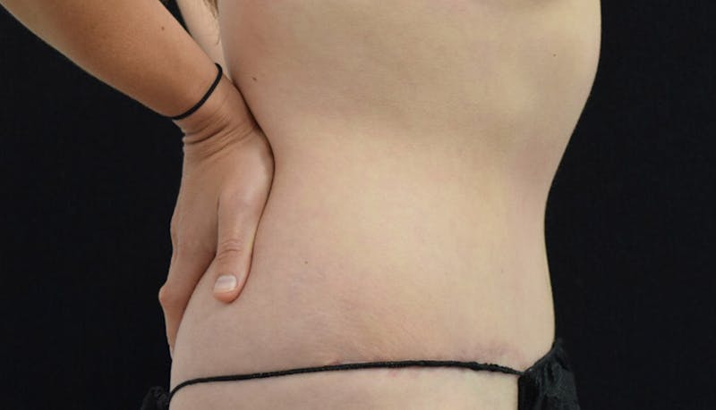 Abdominoplasty Before & After Gallery - Patient 102425575 - Image 10