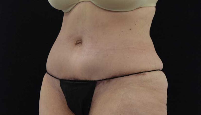 Massive Weight Loss Before & After Gallery - Patient 102425578 - Image 10