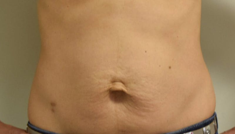 Abdominoplasty Before & After Gallery - Patient 102425607 - Image 1