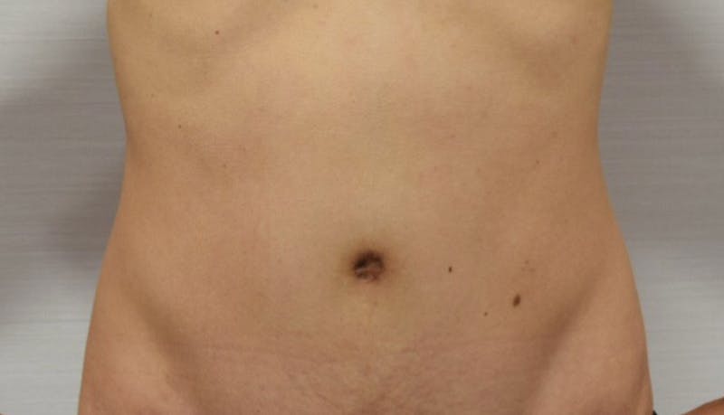 Abdominoplasty Before & After Gallery - Patient 102425607 - Image 2