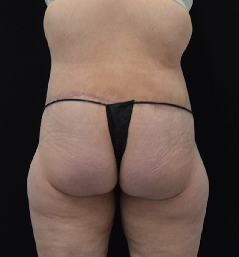 Lower Body Lift Before & After Gallery - Patient 102425579 - Image 12