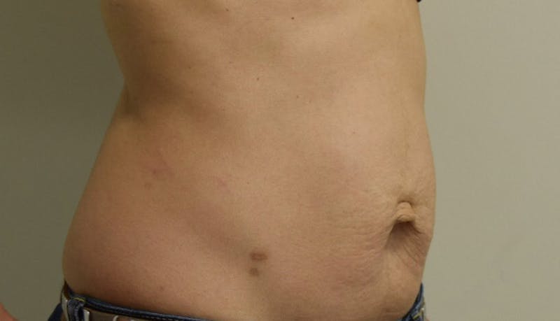Abdominoplasty Before & After Gallery - Patient 102425607 - Image 3