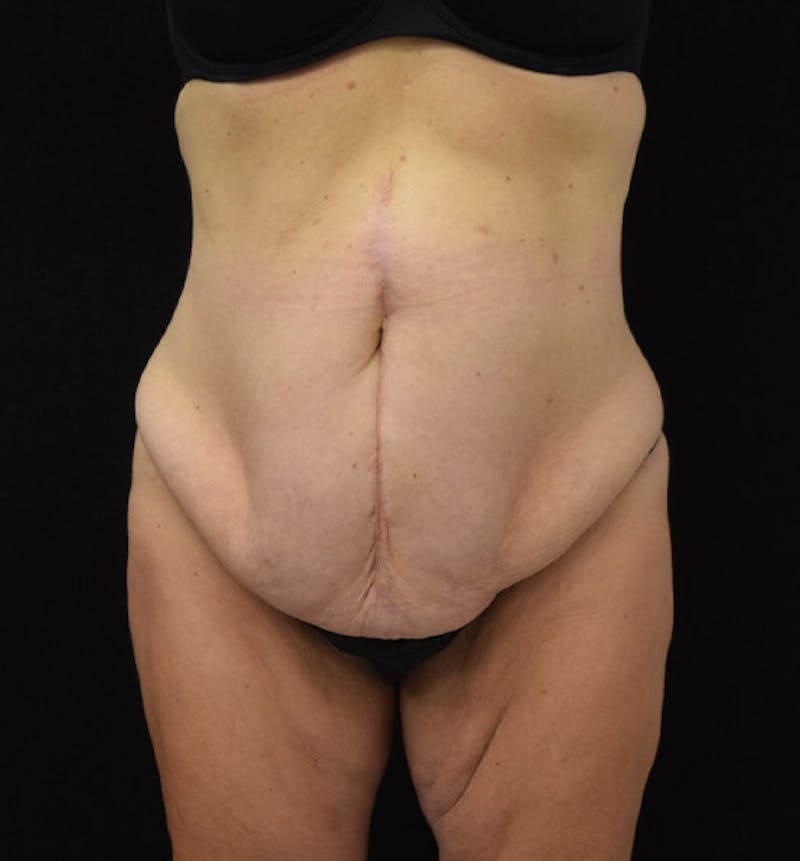 Lower Body Lift Before & After Gallery - Patient 102425609 - Image 1