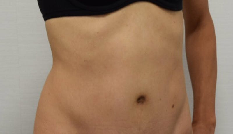 Abdominoplasty Before & After Gallery - Patient 102425607 - Image 4