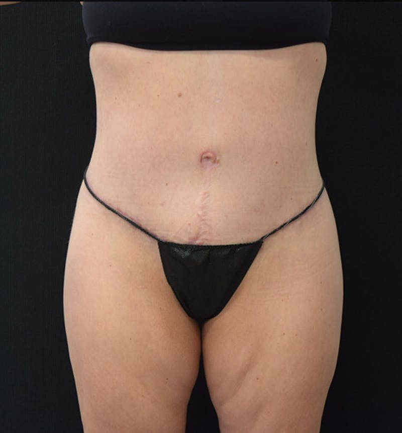 Lower Body Lift Before & After Gallery - Patient 102425609 - Image 2