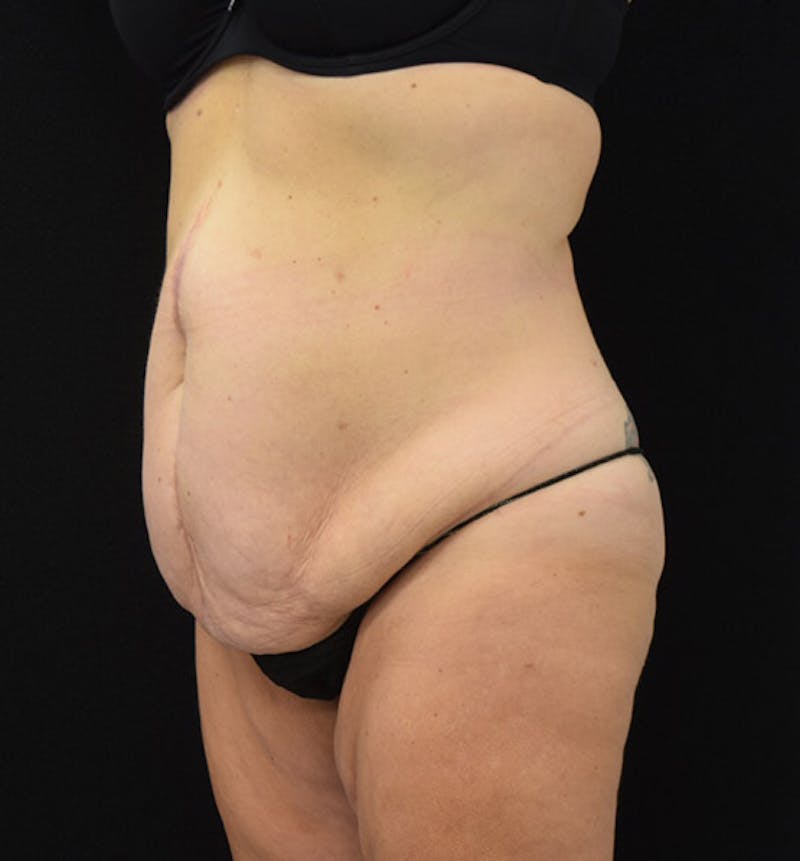 Lower Body Lift Before & After Gallery - Patient 102425609 - Image 3