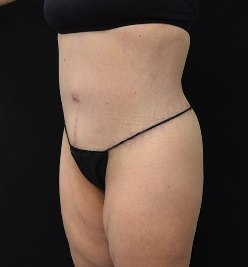 Lower Body Lift Gallery - Patient 102425609 - Image 4