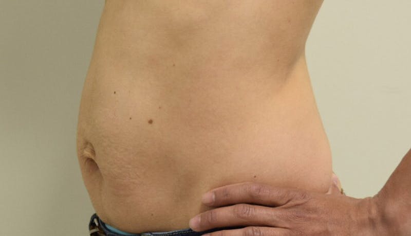 Abdominoplasty Before & After Gallery - Patient 102425607 - Image 5