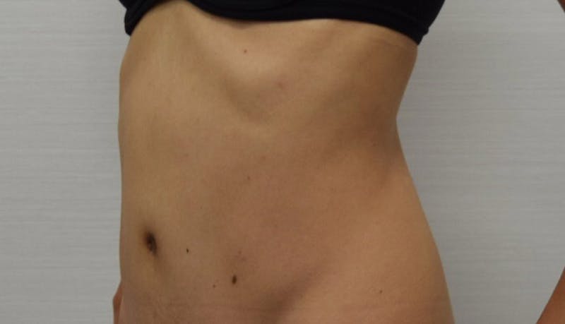 Abdominoplasty Before & After Gallery - Patient 102425607 - Image 6