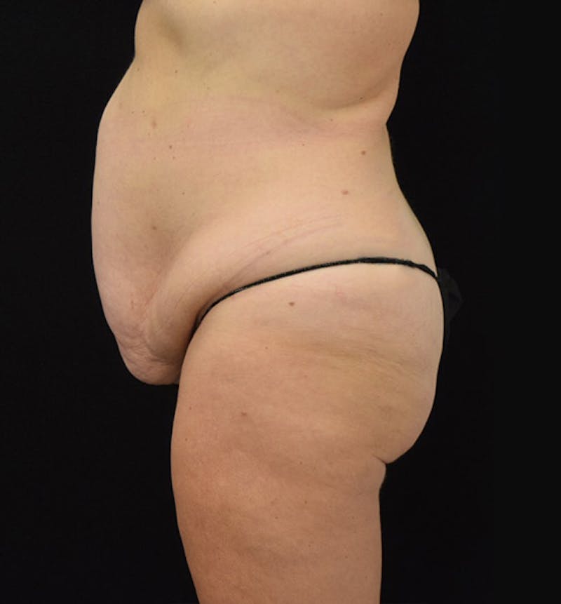 Lower Body Lift Before & After Gallery - Patient 102425609 - Image 5