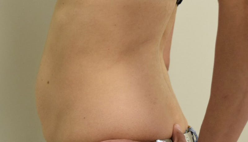 Abdominoplasty Before & After Gallery - Patient 102425607 - Image 7