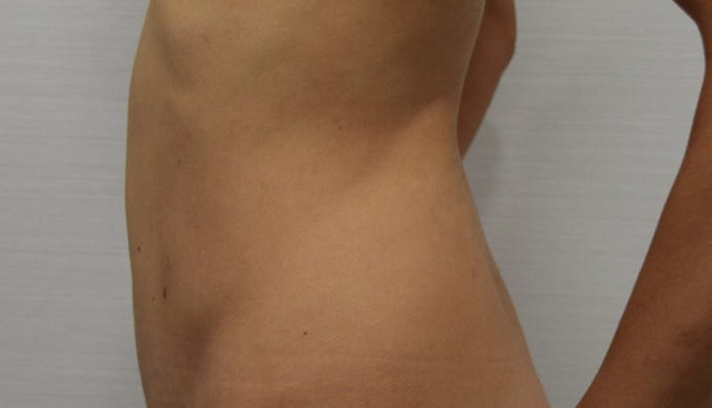 Abdominoplasty Before & After Gallery - Patient 102425607 - Image 8
