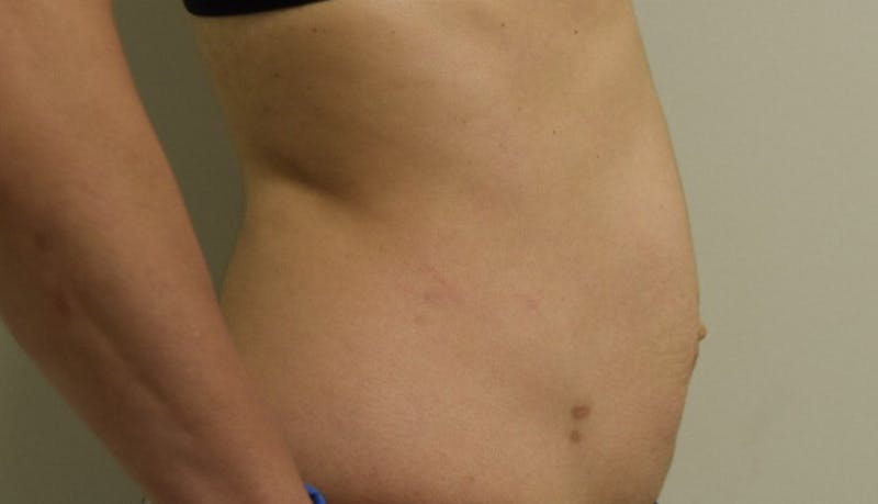 Abdominoplasty Before & After Gallery - Patient 102425607 - Image 9