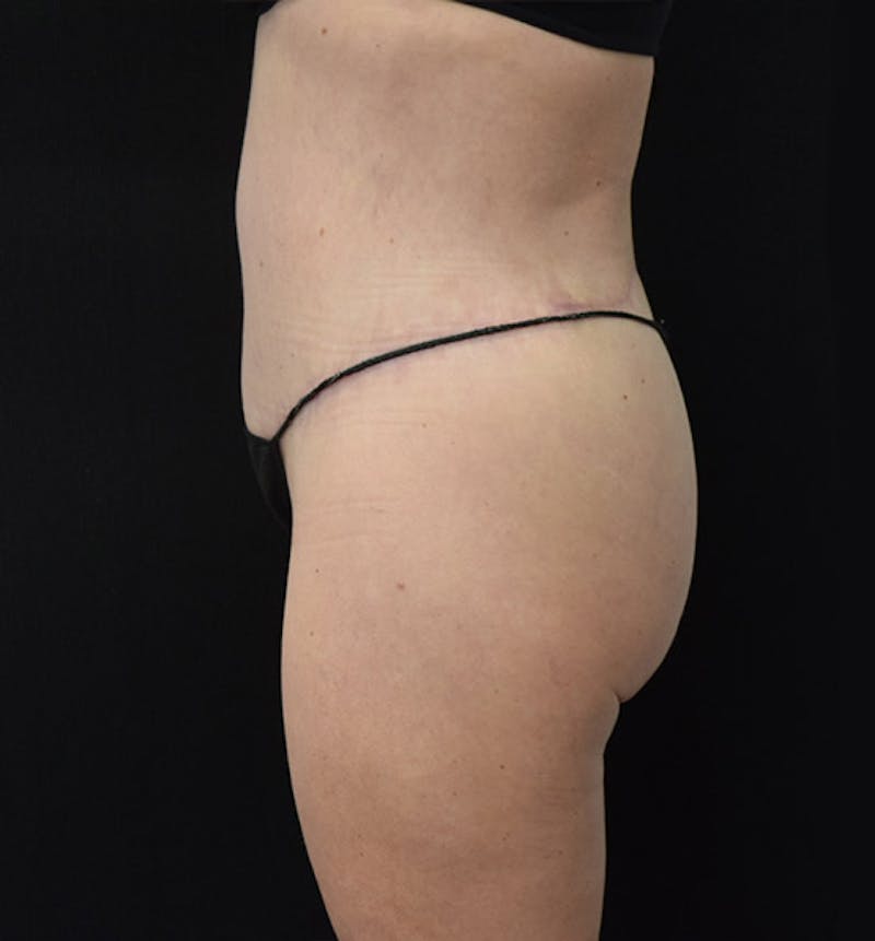 Lower Body Lift Gallery - Patient 102425609 - Image 6