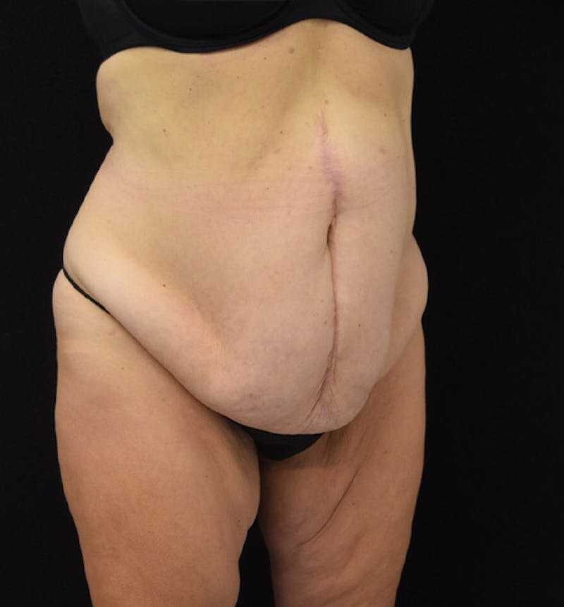 Lower Body Lift Before & After Gallery - Patient 102425609 - Image 7