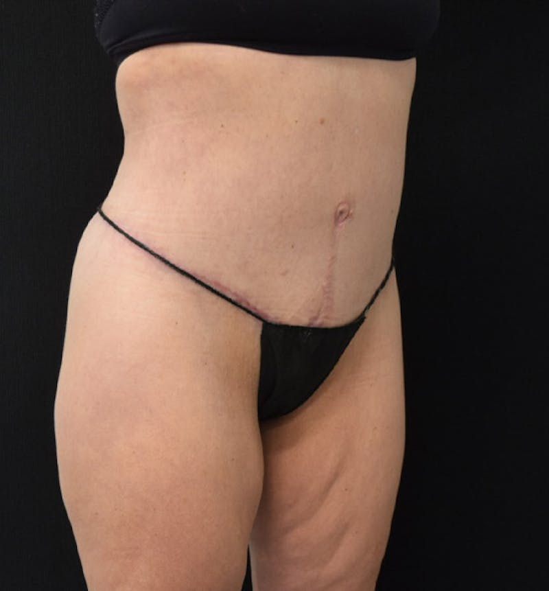 Lower Body Lift Gallery - Patient 102425609 - Image 8