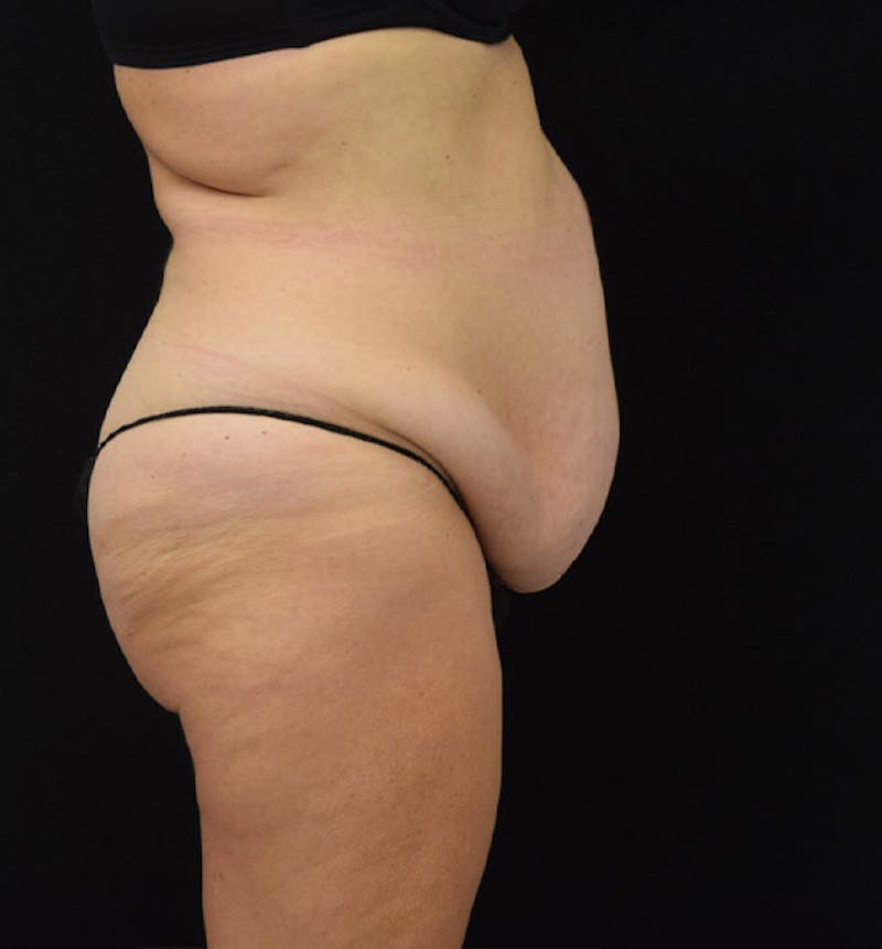 Lower Body Lift Before & After Gallery - Patient 102425609 - Image 9