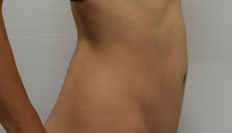 Abdominoplasty Before & After Gallery - Patient 102425607 - Image 10