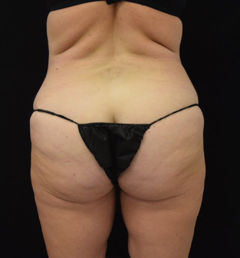 Lower Body Lift Before & After Gallery - Patient 102425609 - Image 11