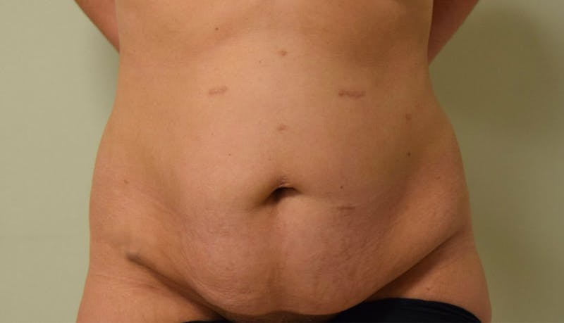 Abdominoplasty Before & After Gallery - Patient 102425695 - Image 1