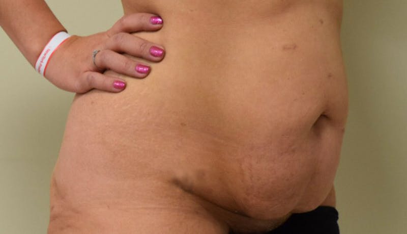 Abdominoplasty Before & After Gallery - Patient 102425695 - Image 3