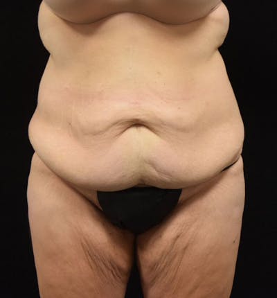 Lower Body Lift Before & After Gallery - Patient 102425719 - Image 1