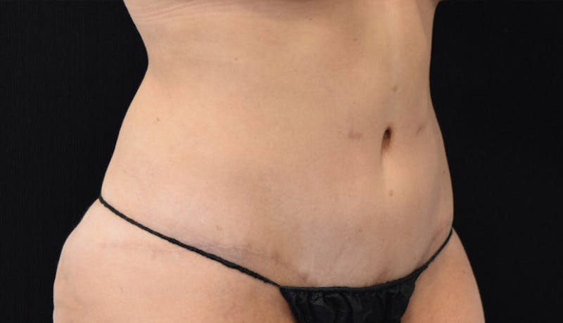 Abdominoplasty Before & After Gallery - Patient 102425695 - Image 4