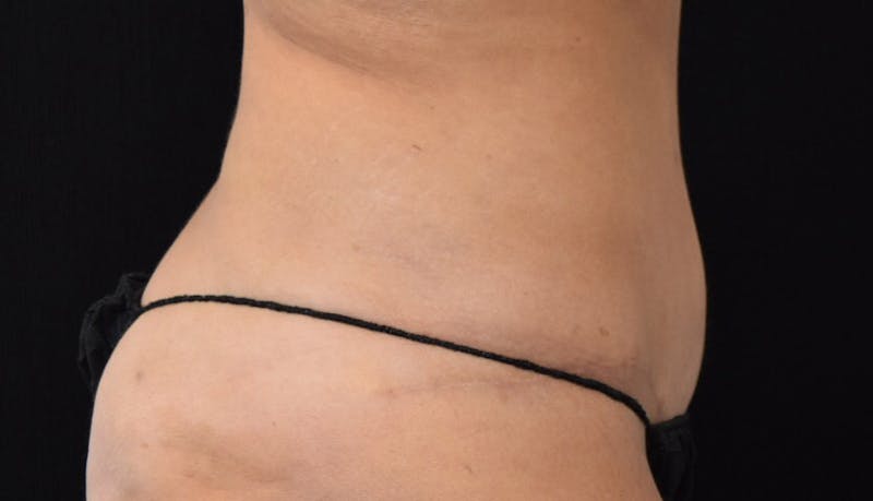 Abdominoplasty Before & After Gallery - Patient 102425695 - Image 6