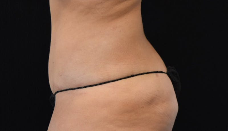 Abdominoplasty Before & After Gallery - Patient 102425695 - Image 8