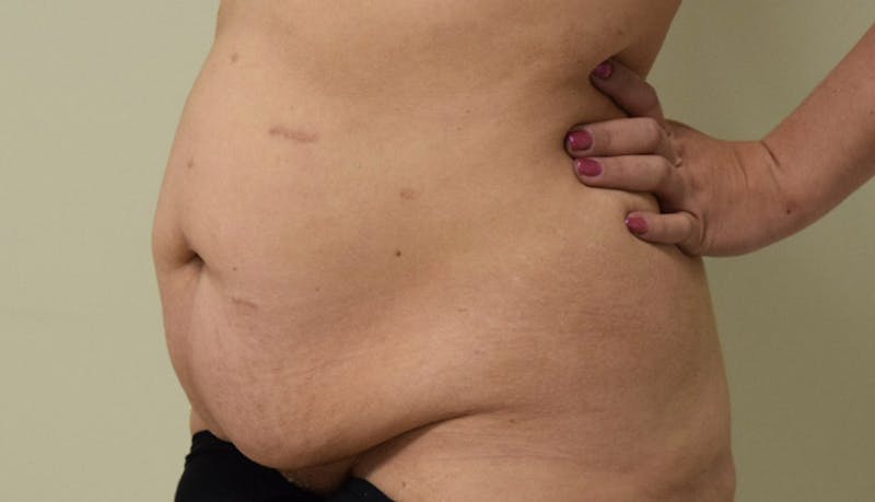 Abdominoplasty Before & After Gallery - Patient 102425695 - Image 9