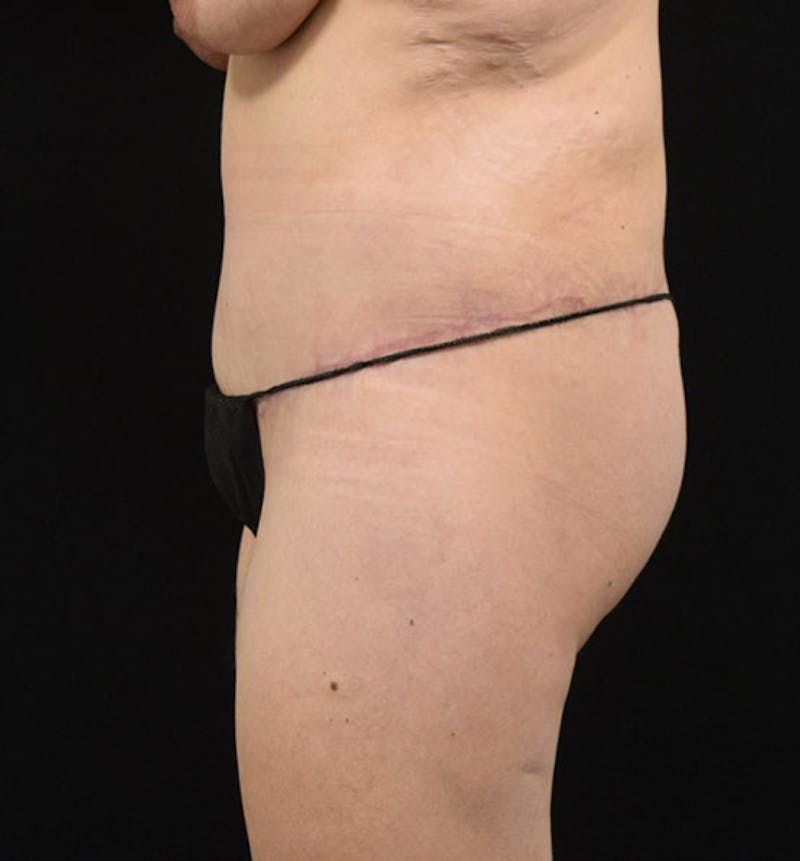 Lower Body Lift Before & After Gallery - Patient 102425719 - Image 6