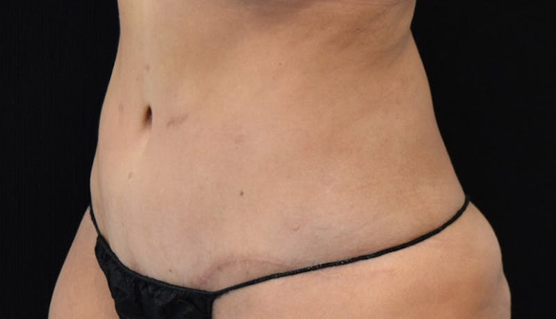 Abdominoplasty Before & After Gallery - Patient 102425695 - Image 10