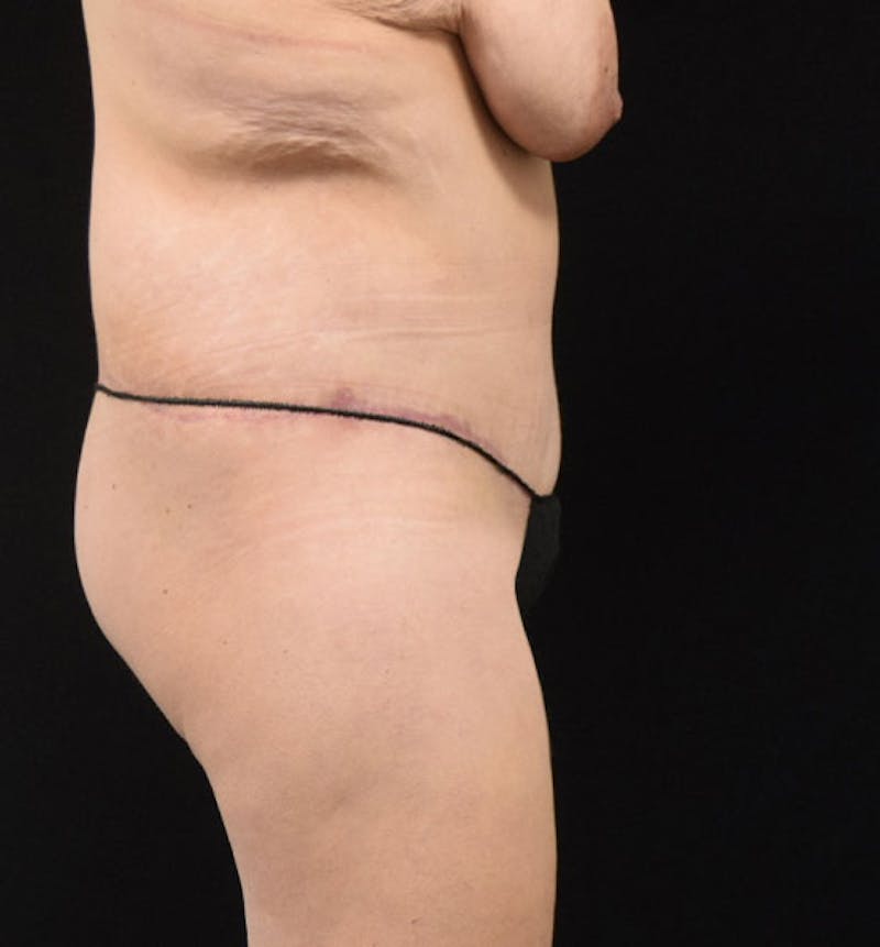 Lower Body Lift Before & After Gallery - Patient 102425719 - Image 10