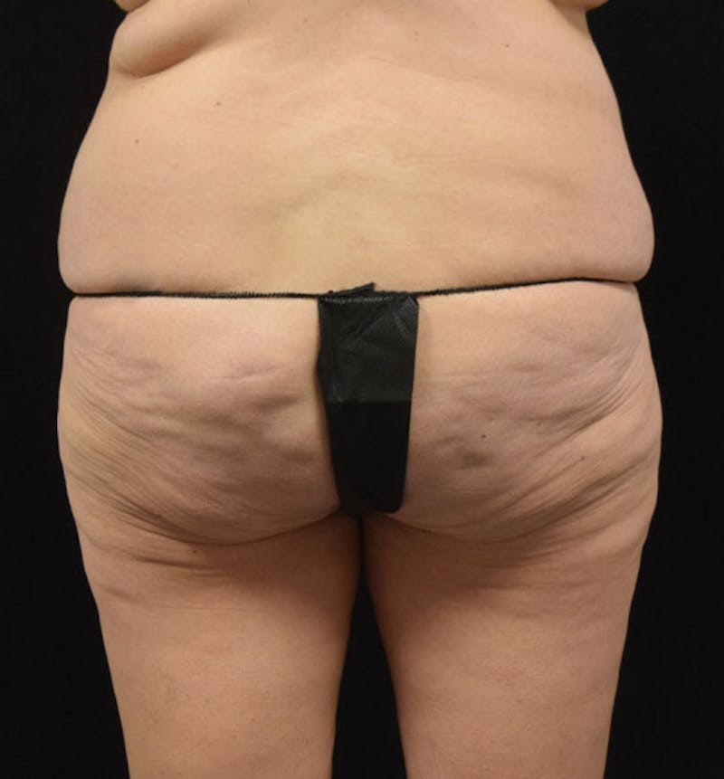 Lower Body Lift Before & After Gallery - Patient 102425719 - Image 11