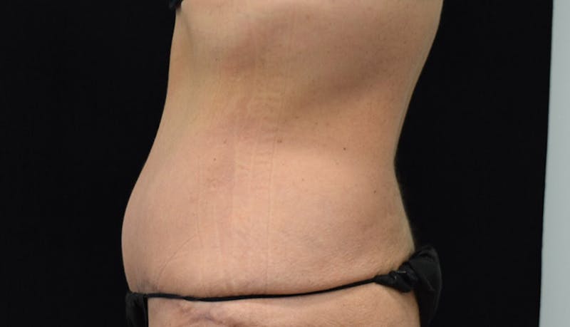 Abdominoplasty Before & After Gallery - Patient 102425739 - Image 6