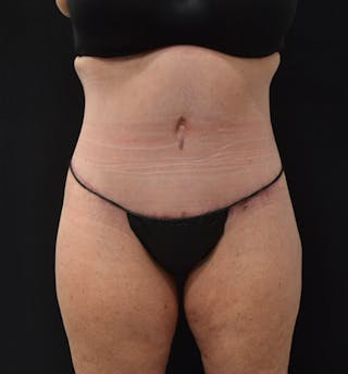 Lower Body Lift Before & After Gallery - Patient 102425763 - Image 2