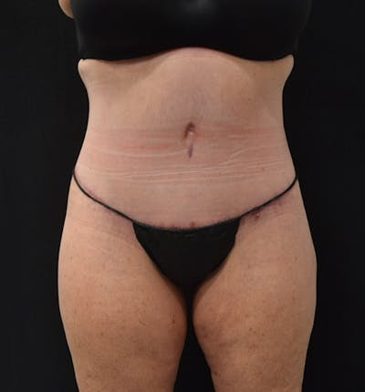 Lower Body Lift Before & After Gallery - Patient 102425763 - Image 2