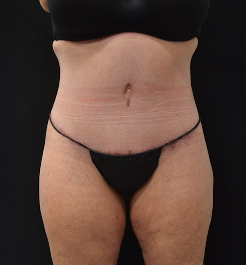 Lower Body Lift Before & After Gallery - Patient 102425763 - Image 2