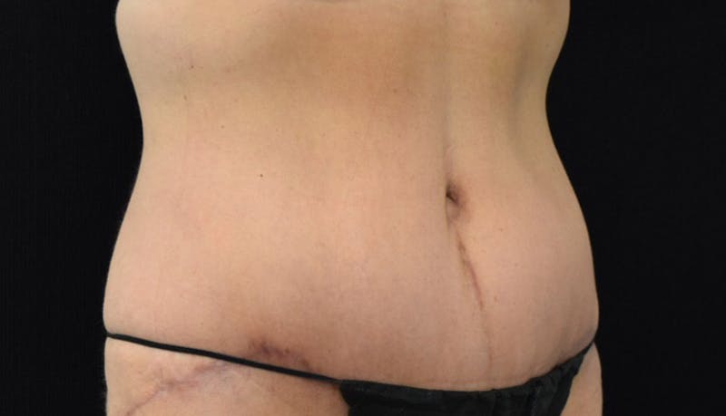 Abdominoplasty Before & After Gallery - Patient 102425739 - Image 8