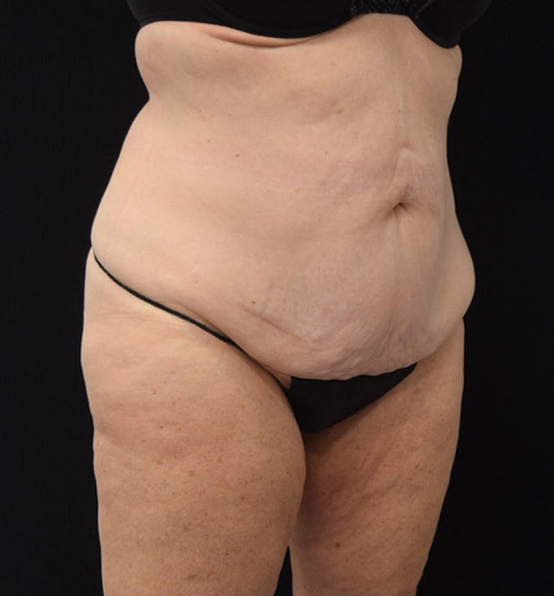 Lower Body Lift Before & After Gallery - Patient 102425763 - Image 3