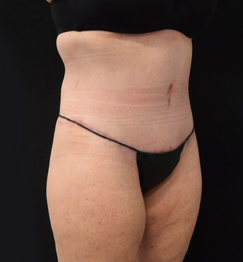 Lower Body Lift Before & After Gallery - Patient 102425763 - Image 4