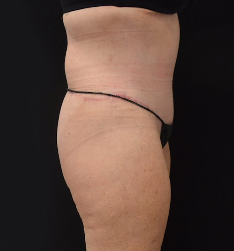 Lower Body Lift Before & After Gallery - Patient 102425763 - Image 6
