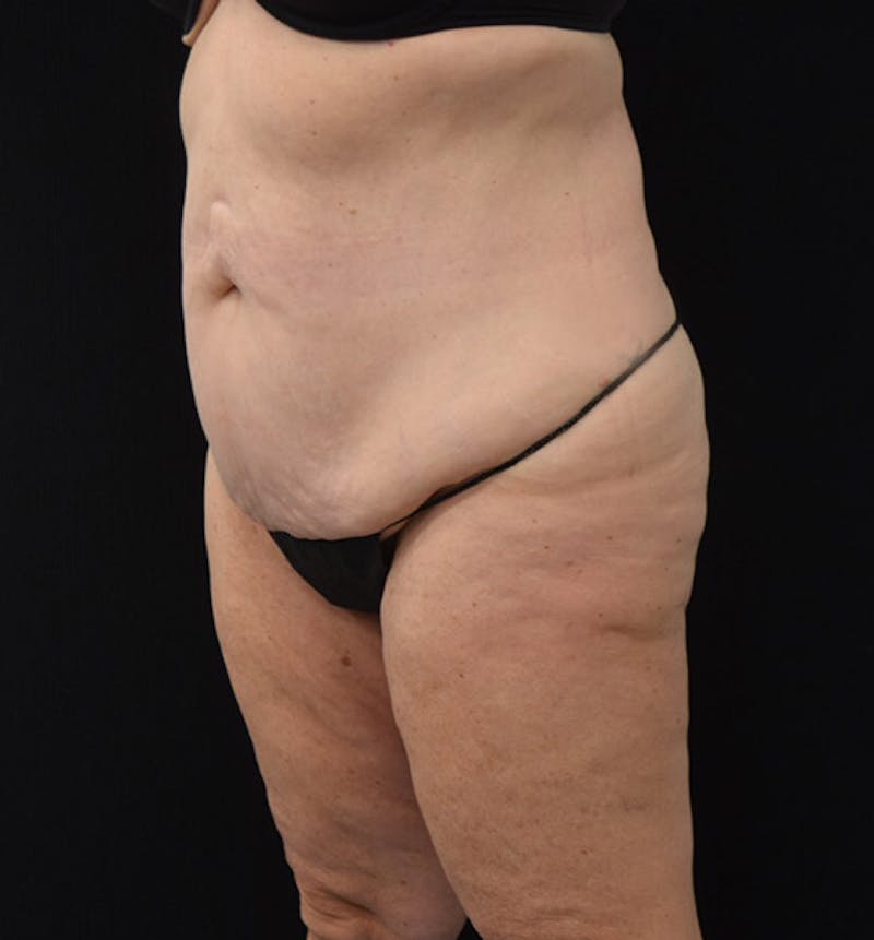 Lower Body Lift Before & After Gallery - Patient 102425763 - Image 7