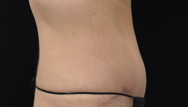 Abdominoplasty Before & After Gallery - Patient 102425739 - Image 10