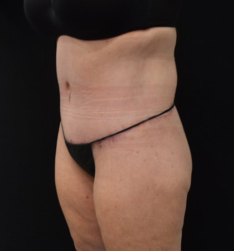 Lower Body Lift Before & After Gallery - Patient 102425763 - Image 8