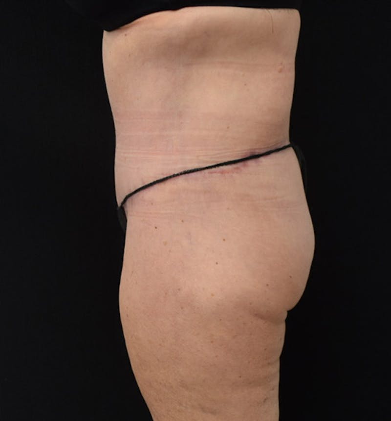 Lower Body Lift Before & After Gallery - Patient 102425763 - Image 10